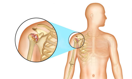 Артрит или воспаление плеча