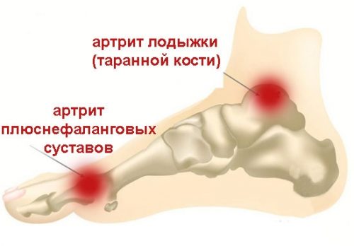 Расположение артрита стопы