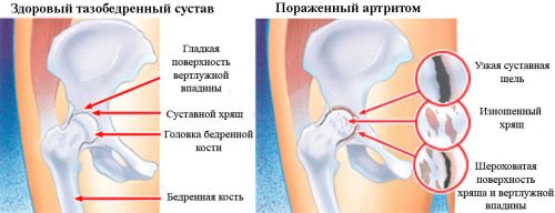 Изменения при артрите тазобедренного сустава