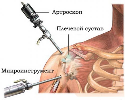 Процедура артроскопия плечевого сустава