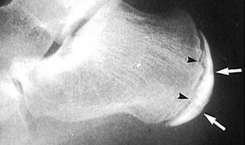 Болезнь Хаглунда – Шинца на рентген снимке