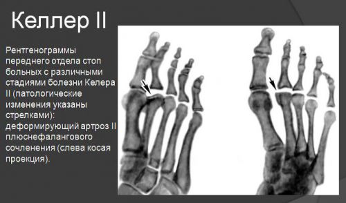 Болезнь Келлера 2 вида на рентген снимке