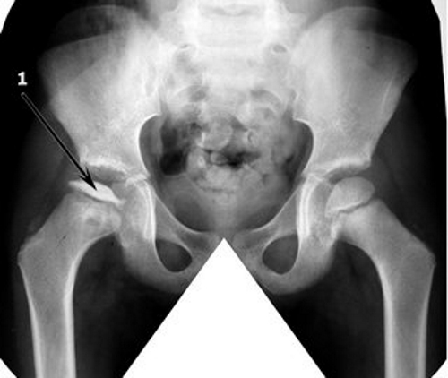 Болезнь Пертеса на рентген снимке