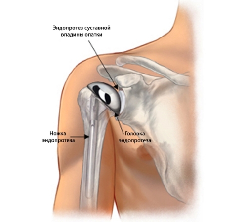 Эндопротезирование плечевого сустава