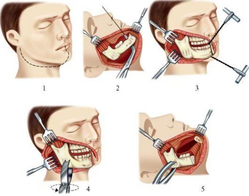 Этапы операции резекции нижней челюсти с вычленением в суставе