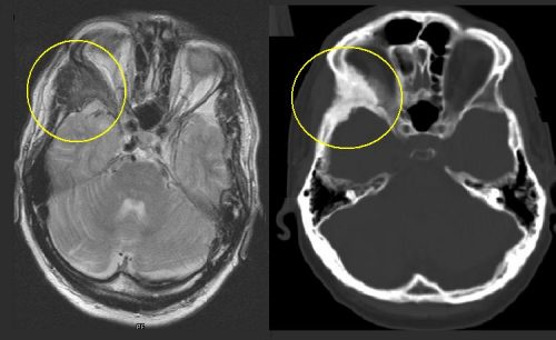 Фиброзная дисплазия черепа на МРТ