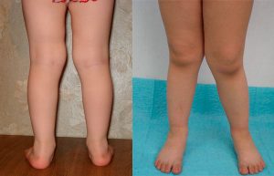 Вальгусная деформация ног у детей
