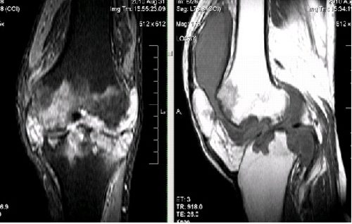 Гемартроз коленного сустава на МРТ снимке
