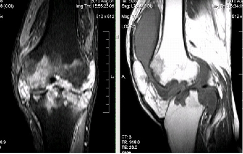 Гемартроз на МРТ снимке