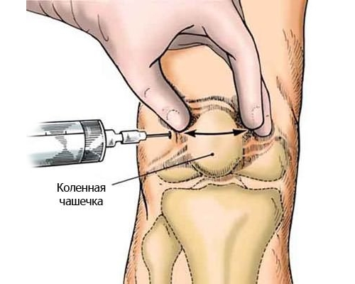 Инъекции при бурсите коленного сустава