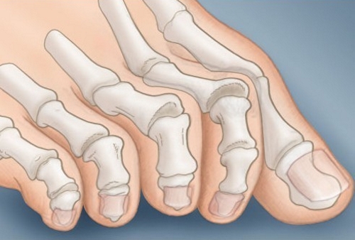 Проблема искривления пальцев на ногах