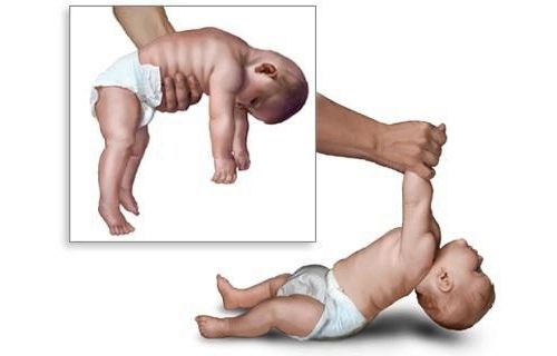 Проявление мышечной гипотонии у ребенка