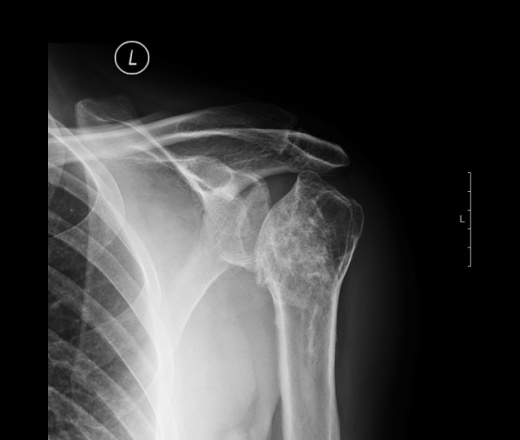 Некроз плечевой кости на рентгене