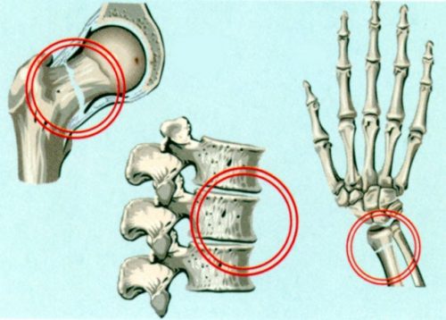Области, в наибольшей степени подверженные переломам при остеопорозе
