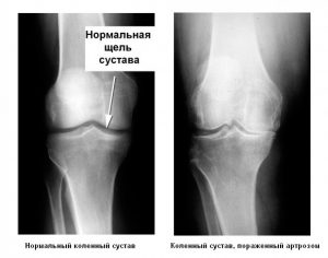 Остеоартроз колена на рентген снимке