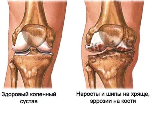 Остеофиты коленного сустава