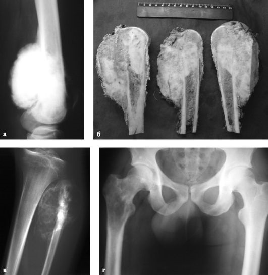 Остеогенная саркома бедра и малоберцовой кости на рентгене