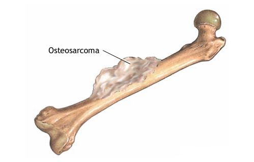 Костная опухоль — остеосаркома 