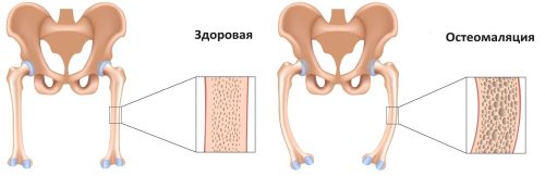 Остеомаляция кости