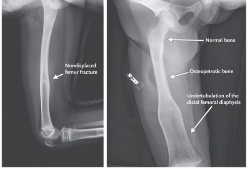 Остеопетроз на рентген снимке