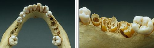 Разрушение челюсти при остеопорозе