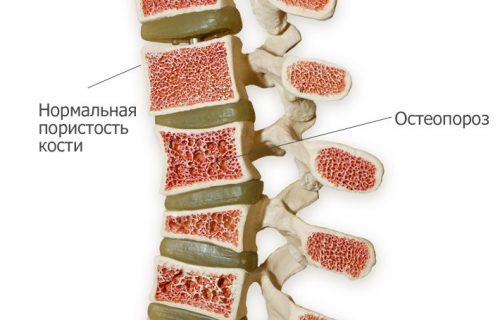 Проблема остеопороза позвоночника