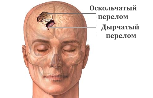 Виды перелома лобной кости черепа