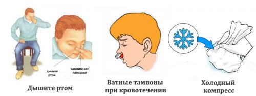 Первая помощь при переломе носа
