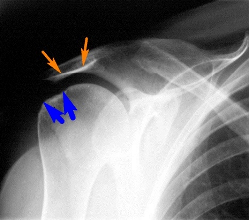 Плечевой артрит на рентгене