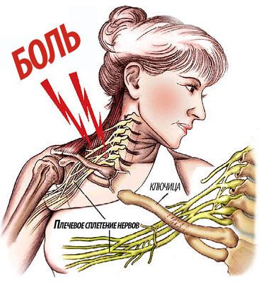 Боль при плексите плечевого сустава
