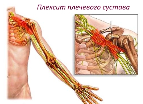 Воспаление нервов плечевого сустава