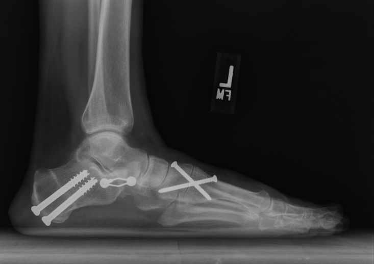 Подтаранный артроэрез на рентген снимке