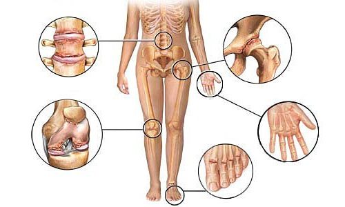 Полиостеоартроз суставов и хрящей