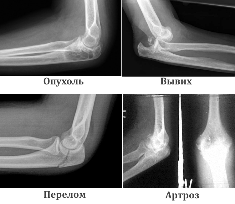 Повреждения костей локтевого сустава на рентгене