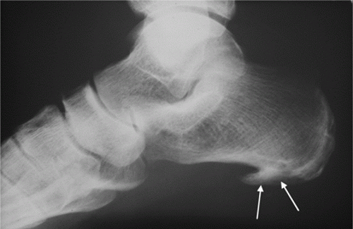 Пяточная шпора на рентген снимке