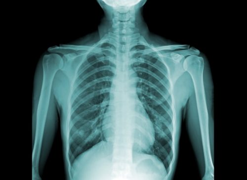 Проведение рентгена грудного отдела позвоночника