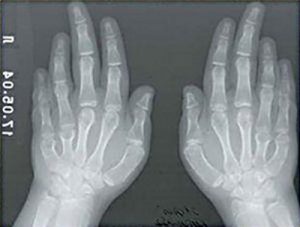 Рентгеновский снимок рук