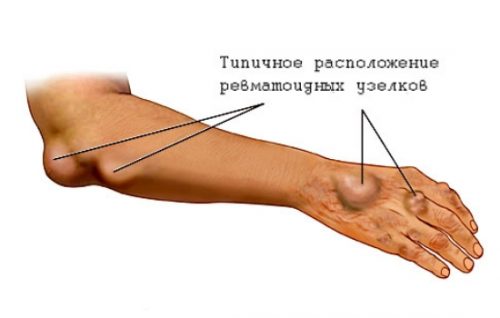 Ревматоидные узелки при артрите