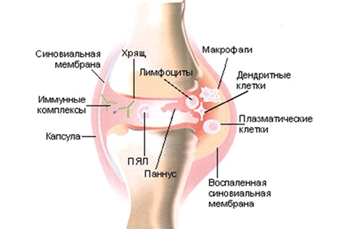 Ревматоидный артрит