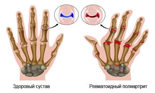 Ревматоидный полиартрит пальцев рук