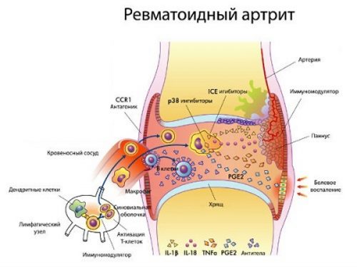 Схема ревматоидного артрита