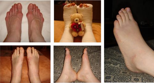 Результаты остеотомии большого пальца стопы