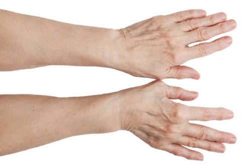 Появление шишки на суставе большого пальца руки