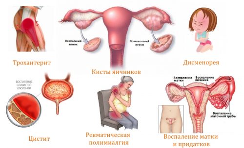 Симптомы поясничной боли у женщин