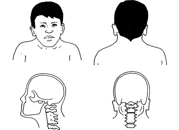 Синдром короткой шеи или Клиппеля–Фейля