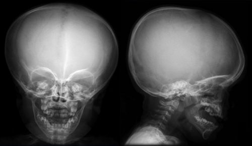 Рентген диагностика синдром Парро-Мари головы