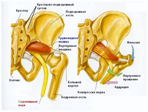 Схема синдрома грушевидной мышцы