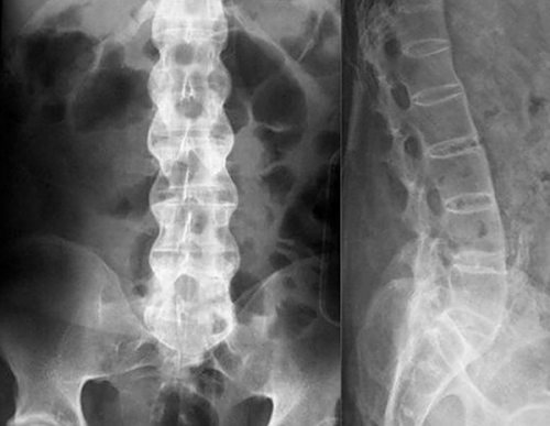 Спондилоартроз пояснично–крестцового отдела позвоночника рентген