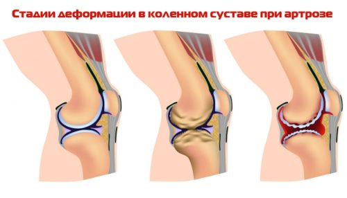 Стадии остеоартроза коленного сустава