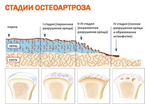 Стадии остеоартроза